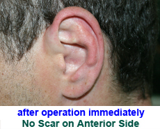 plastic-surgery-prominent-ear 